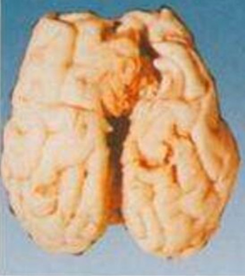 细菌性脑膜炎的脑图片