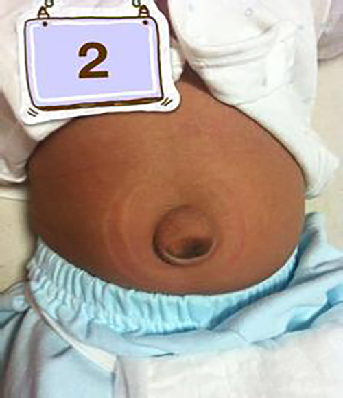 新生儿腹部鼓鼓的图片图片