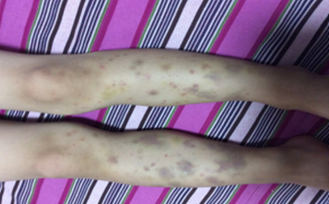 紫癜性肾炎的临床表现图片