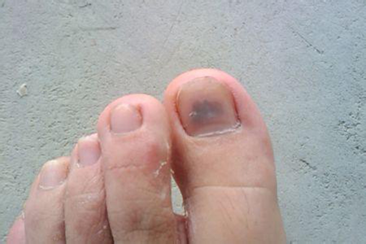 灰指甲初期症状 最初图片