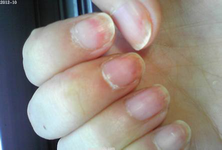 灰指甲的初期症状有哪些图片