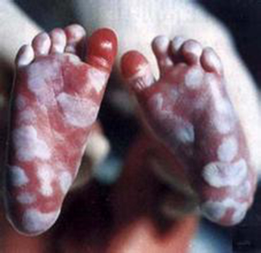 早期梅毒感染症状图图片