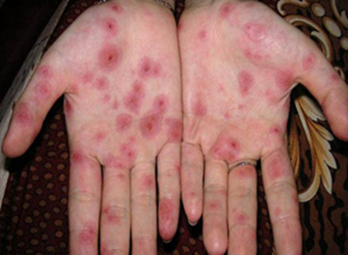 梅毒初期红疹图片图片