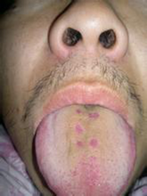 梅毒病人的舌头图片图片