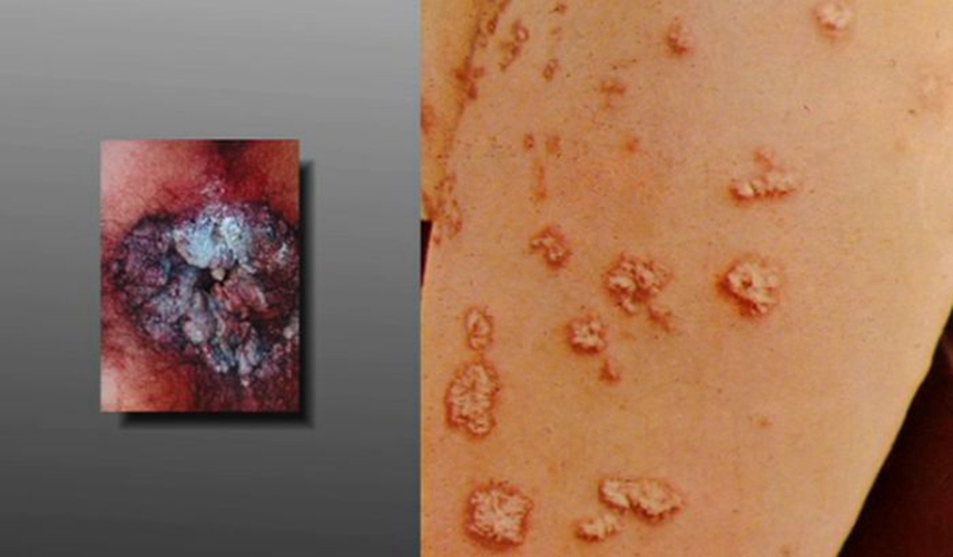 梅毒感染身上长红疙瘩图片