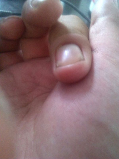 手指甲周炎早期图片