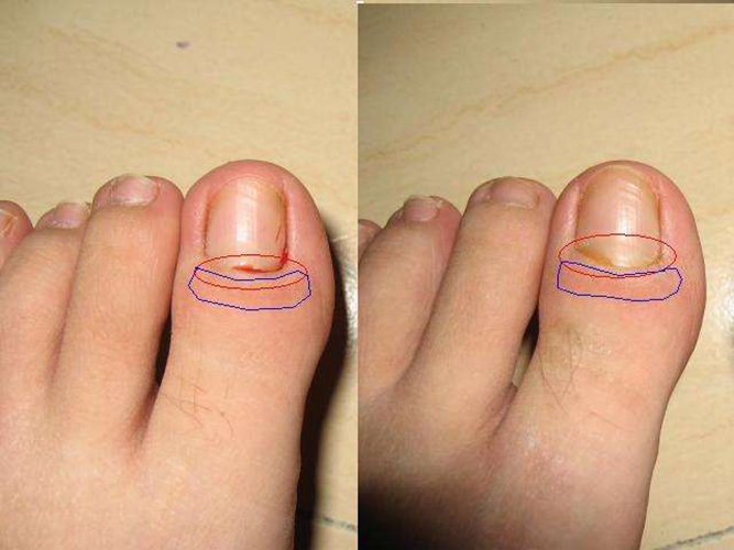 指甲沟是哪个位置图片图片