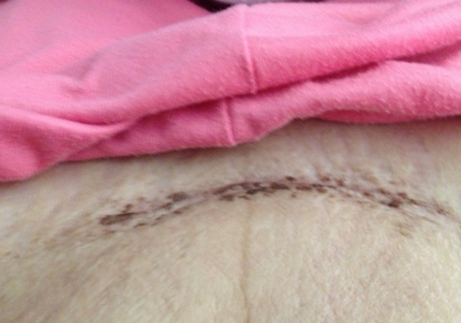 剖腹产疤痕恢复过程图图片
