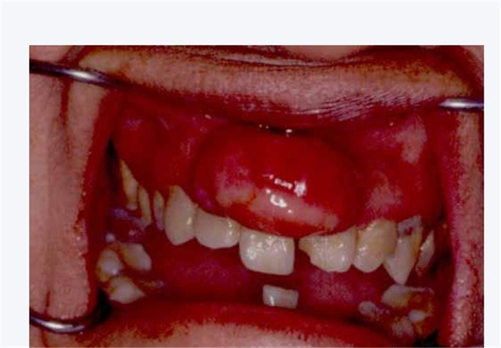 肉芽肿型牙龈瘤图片