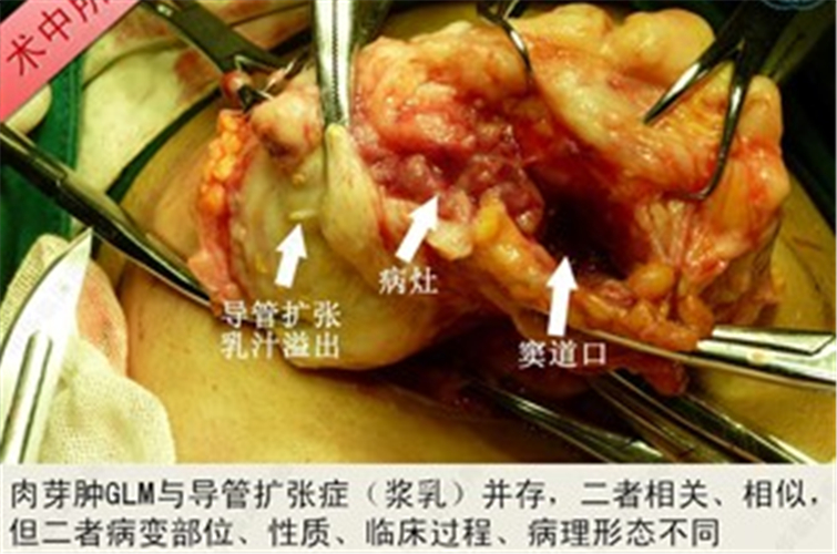 肉芽肿手术治疗图片
