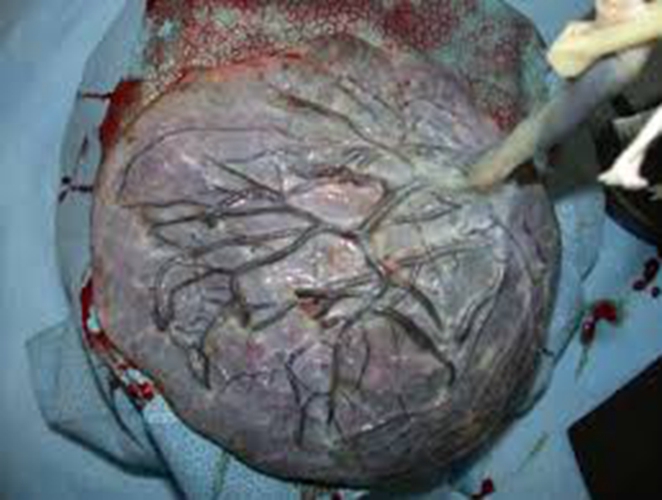 人胎盘具体的形态图片