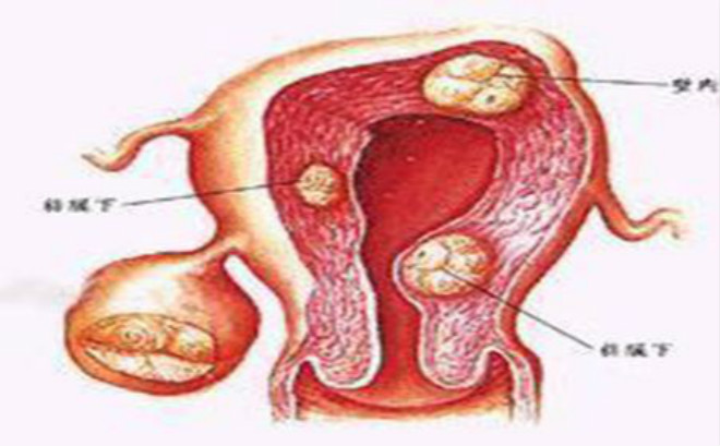 女性前庭大腺炎图片