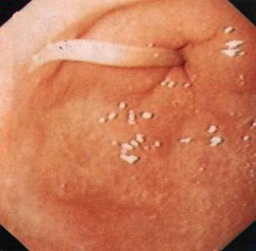 胆道蛔虫病症状的图片