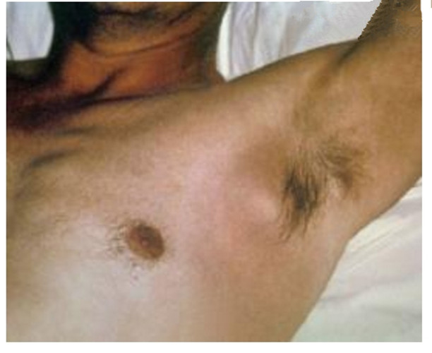 腋下淋巴癌的症状图片