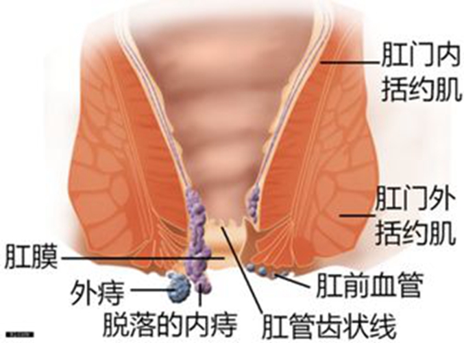 女性痔疮症状