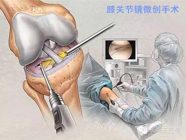 如果仍診斷不明,現在還有了另一種可靠的診療技術——關節鏡技術