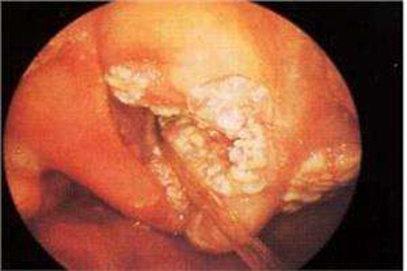 牙龈癌早期症状图片(2)