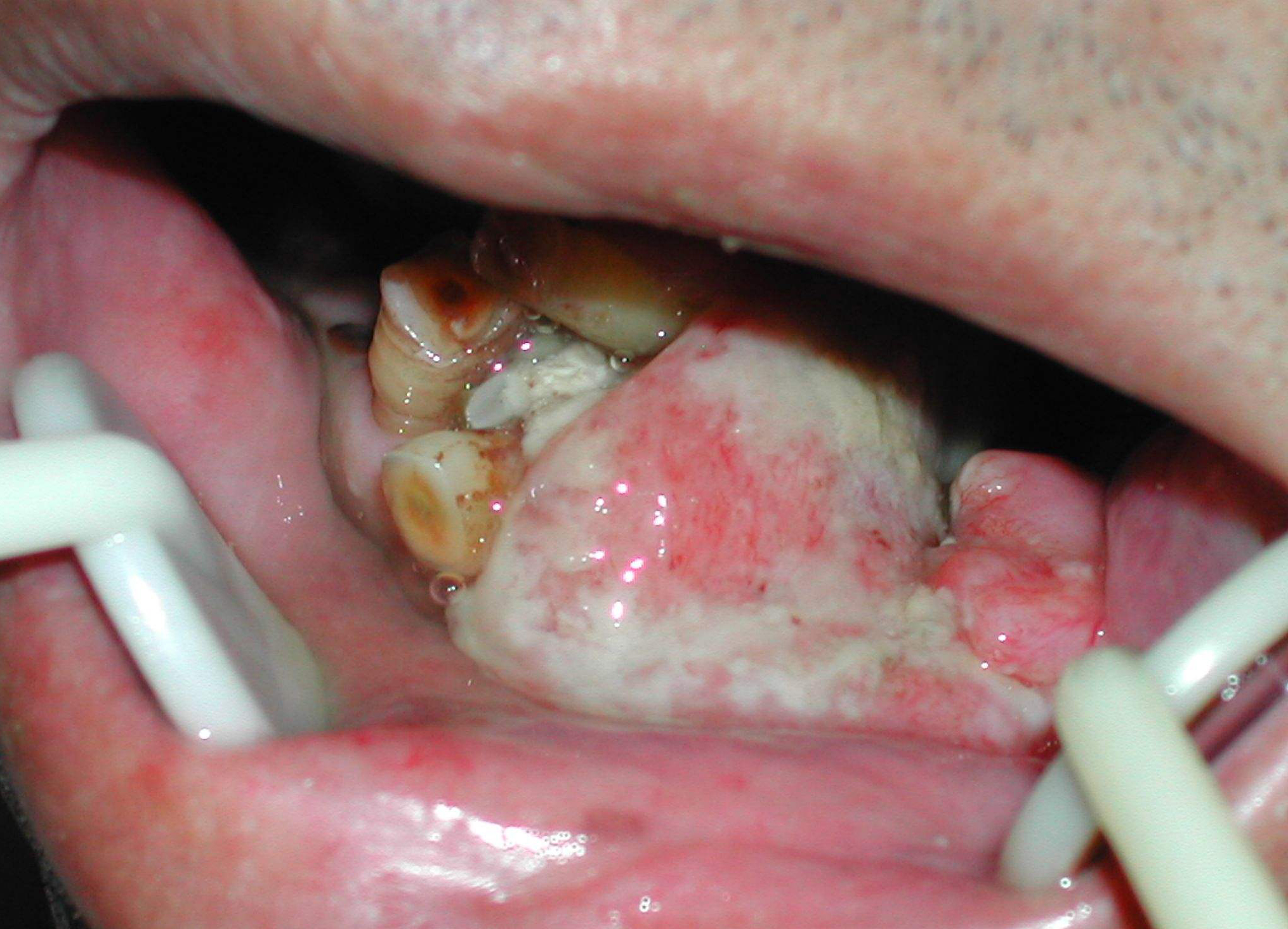 牙癌的早期症状图牙齿图片