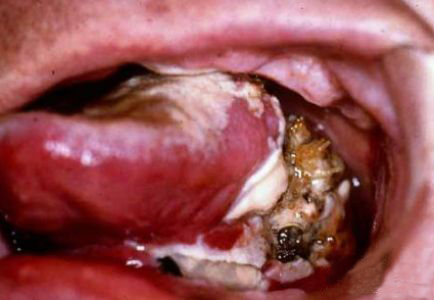 牙癌有什么症状图片