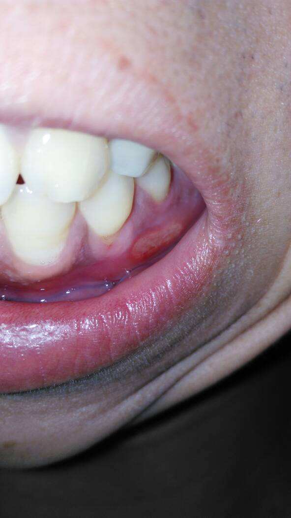 牙癌的早期症状图牙齿图片