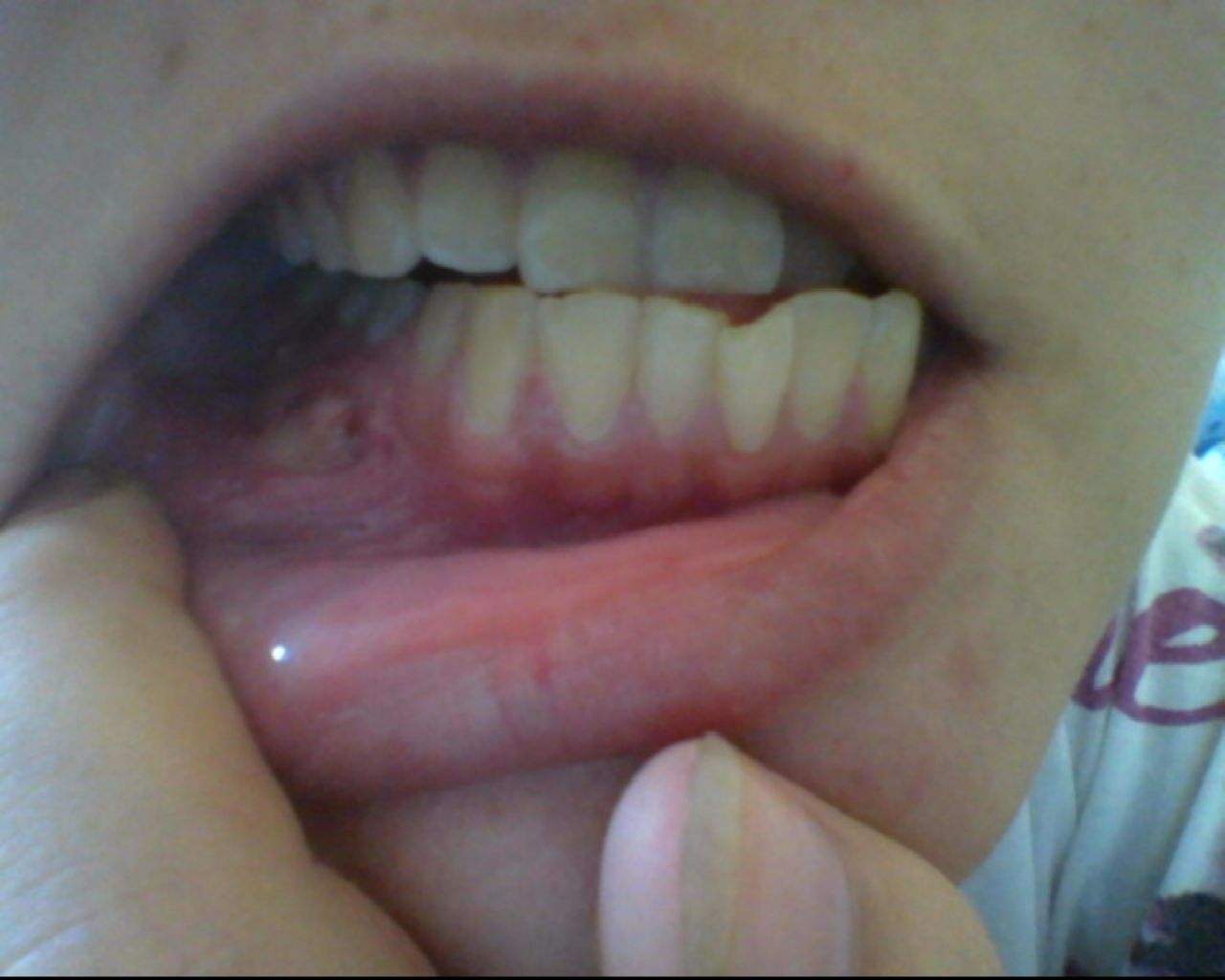 牙龈癌早期症状图片(55)