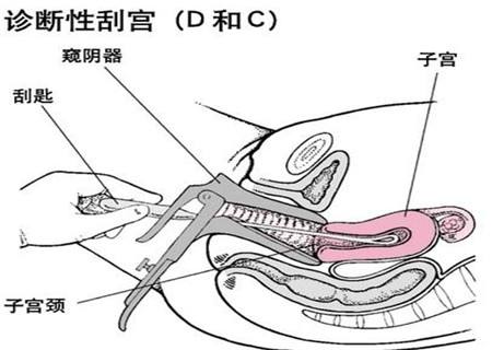 刮宫手术过程图片(56)