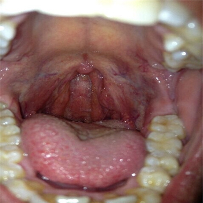 咽喉癌早期图片图片