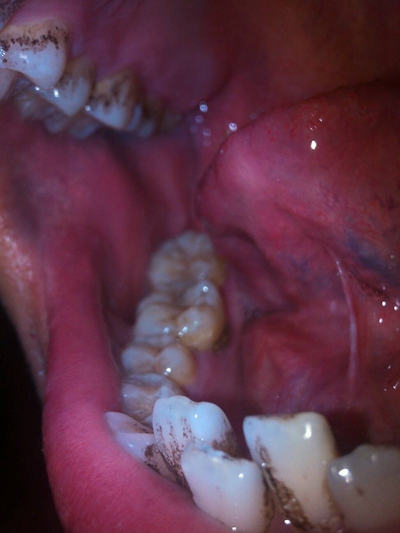 牙齿发黑图片 (3)