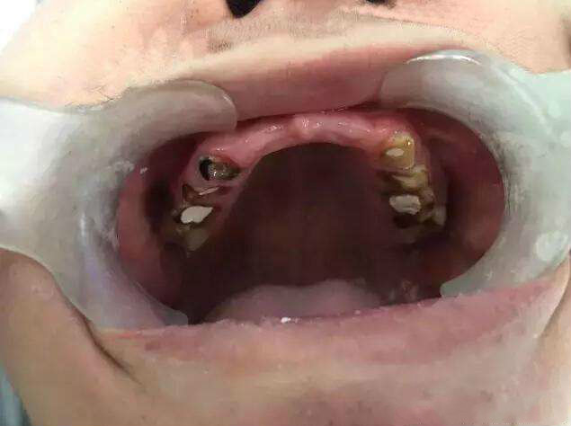 汞中毒牙齿图片图片