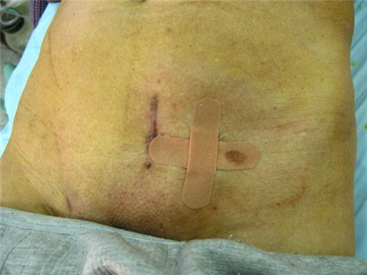肠套叠手术伤口图片图片