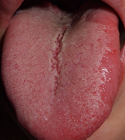 干燥综合症图片舌苔图片