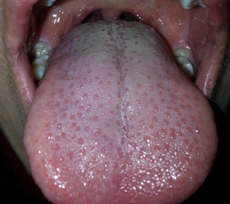 艾滋病舌头图片 (15)