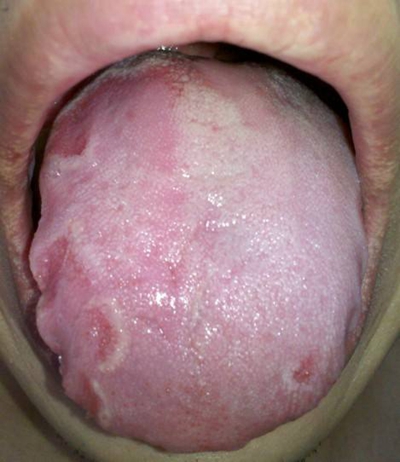 艾滋病皮肤症状舌头图片