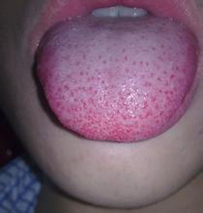舌头上梅毒疹图片图片