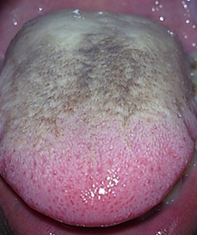 艾滋病舌头长肉芽图片图片