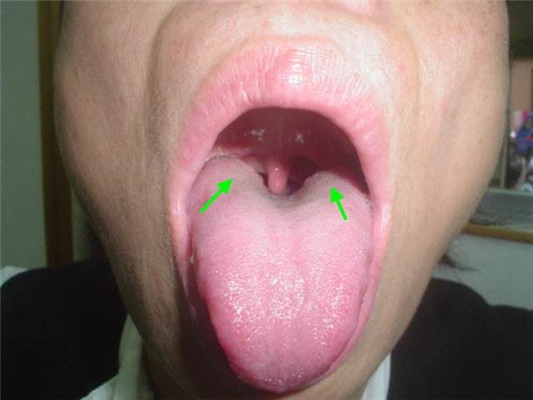 舌滤泡增生照片图片