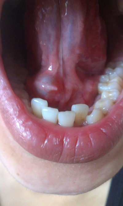 淋菌性咽炎症状图片图片
