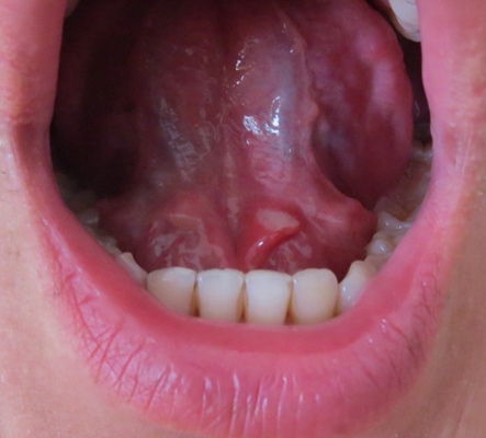 舌头下小肉芽图片图片
