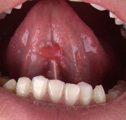 舌下腺长肉疙瘩图图片