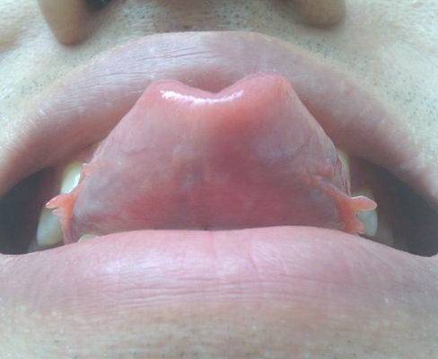 舌下肉阜正常图片