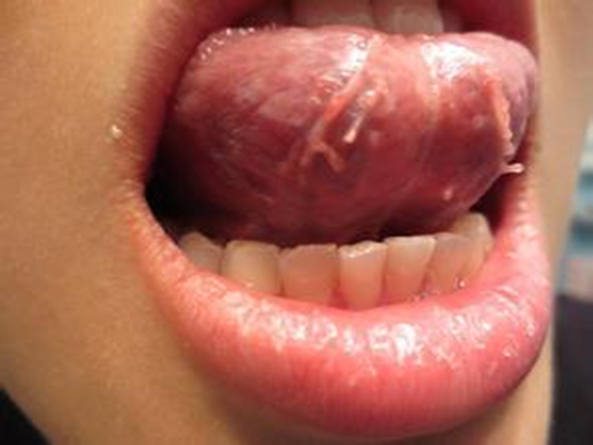 艾滋病舌头下面图片