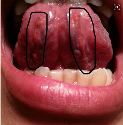 舌头下面有丝状肉芽图片