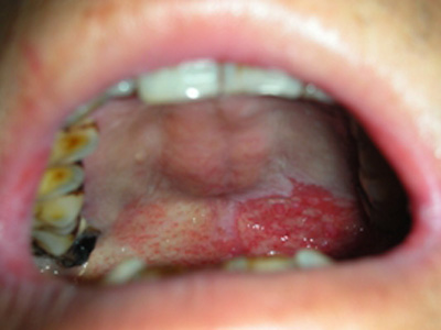 腭咽弓癌早期症状图片图片