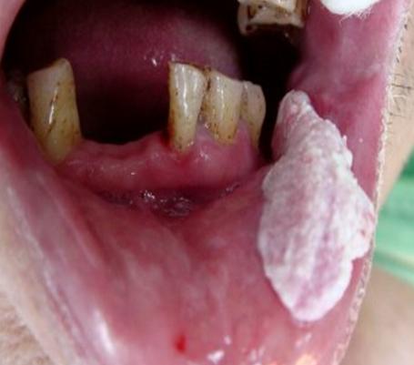 口颊癌的早期症状图片图片