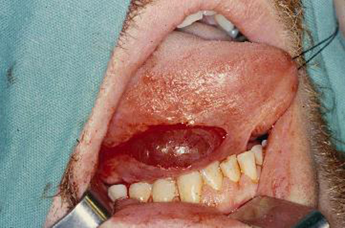 口腔鳞癌早期症状图片图片