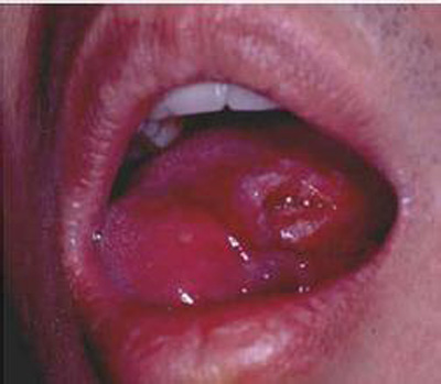 口咽癌图片 初期图片