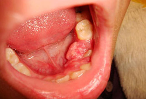 口腔肿瘤早期症状图片图片
