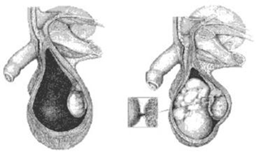 阴茎癌常见症状图片