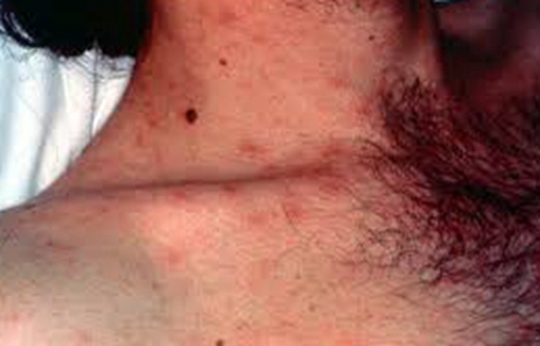 艾滋病初期脖子图片图片