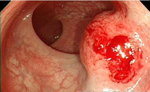 直肠癌早期治疗方案图片